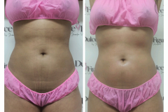 img-procedimiento-corporal-29